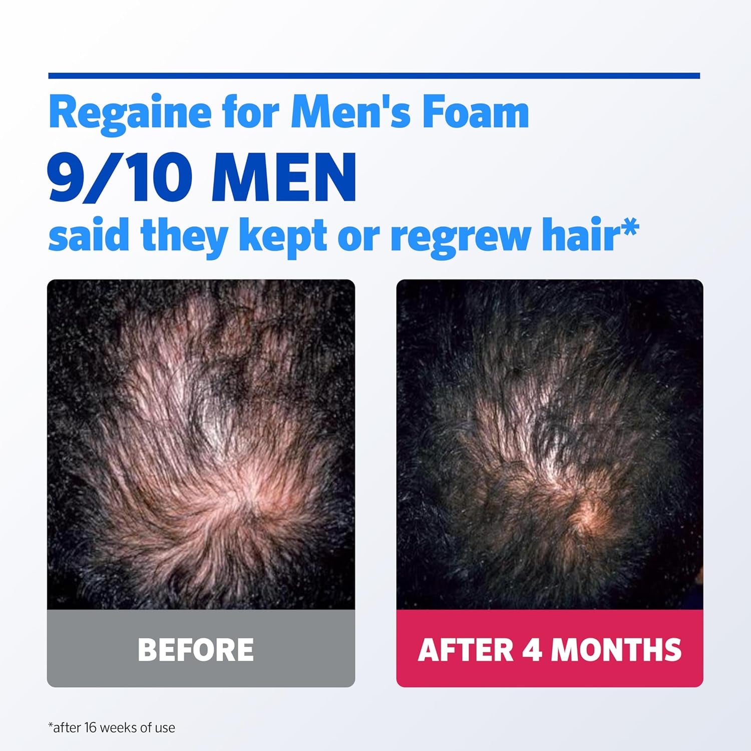 for Men Extra Strength Foam - Scientifically Proven to Help Stop Hereditary Hair Loss - Minoxidil Foam for Hair Regrowth - (3 X 73Ml), Packaging May Vary