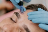 The Science Behind Microneedling: Improve Skin Texture, Reduce Scars, and Enhance Firmness
