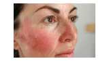 Managing Rosacea: Effective Treatments for Clearer, Calmer Skin
