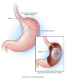 Intragastric Balloon: An Overview