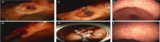 Endoscopic Hemostasis for a Massively Bleeding Large Gastric… : Official journal of the American College of Gastroenterology